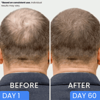 Dual-Applicator Hair Regrowth System