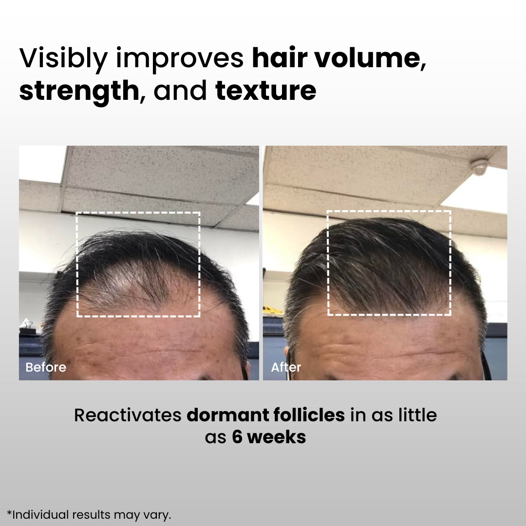 Dual-Applicator Hair Regrowth System